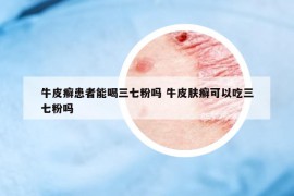 牛皮癬患者能喝三七粉嗎 牛皮膚癬可以吃三七粉嗎