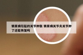 銀屑病引起的關(guān)節(jié)腫脹 銀屑病關(guān)節(jié)炎關(guān)節(jié)腫了還能恢復(fù)嗎