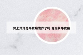 背上洋洋是牛皮癬發(fā)作了嗎 背后長(zhǎng)牛皮癬