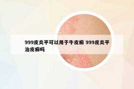 999皮炎平可以用于牛皮癬 999皮炎平治皮癬嗎