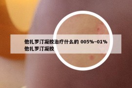 他扎羅汀凝膠治療什么的 005%~01%他扎羅汀凝膠