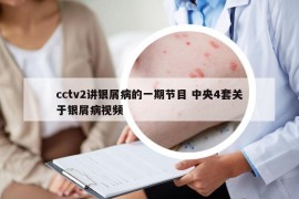 cctv2講銀屑病的一期節(jié)目 中央4套關(guān)于銀屑病視頻