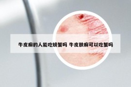 牛皮癬的人能吃螃蟹嗎 牛皮膚癬可以吃蟹嗎