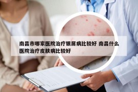南昌市哪家醫(yī)院治療銀屑病比較好 南昌什么醫(yī)院治療皮膚病比較好