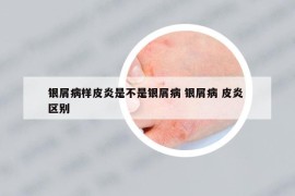 銀屑病樣皮炎是不是銀屑病 銀屑病 皮炎 區(qū)別