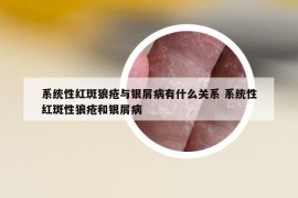 系統(tǒng)性紅斑狼瘡與銀屑病有什么關(guān)系 系統(tǒng)性紅斑性狼瘡和銀屑病