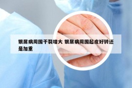 銀屑病周?chē)闪言龃?銀屑病周?chē)鹌ず棉D(zhuǎn)還是加重