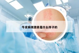 牛皮癬用激素是什么樣子的