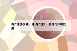 白介素多少錢一針 白介素2一般打幾針有效果