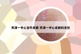 天津一中心治牛皮癬 天津一中心皮膚科主任
