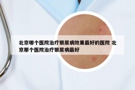 北京哪個(gè)醫(yī)院治療銀屑病效果最好的醫(yī)院 北京那個(gè)醫(yī)院治療銀屑病最好