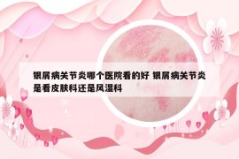 銀屑病關(guān)節(jié)炎哪個(gè)醫(yī)院看的好 銀屑病關(guān)節(jié)炎是看皮膚科還是風(fēng)濕科