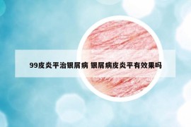 99皮炎平治銀屑病 銀屑病皮炎平有效果嗎