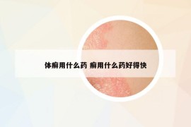 體癬用什么藥 癬用什么藥好得快