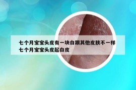 七個月寶寶頭皮有一塊白跟其他皮膚不一樣 七個月寶寶頭皮起白皮