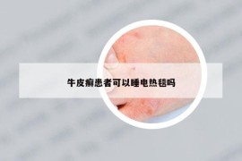 牛皮癬患者可以睡電熱毯嗎