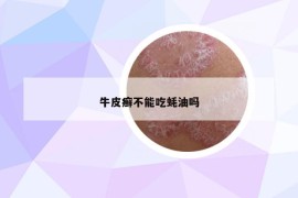 牛皮癬不能吃蠔油嗎