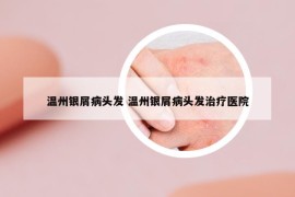 溫州銀屑病頭發(fā) 溫州銀屑病頭發(fā)治療醫(yī)院