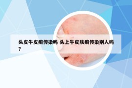頭皮牛皮癬傳染嗎 頭上牛皮膚癬傳染別人嗎?