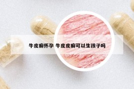 牛皮癬懷孕 牛皮皮癬可以生孩子嗎
