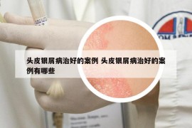 頭皮銀屑病治好的案例 頭皮銀屑病治好的案例有哪些