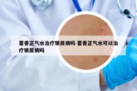 藿香正氣水治療銀屑病嗎 藿香正氣水可以治療銀屑病嗎
