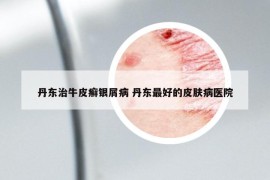 丹東治牛皮癬銀屑病 丹東最好的皮膚病醫(yī)院