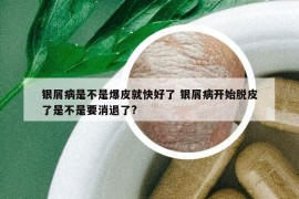 銀屑病是不是爆皮就快好了 銀屑病開(kāi)始脫皮了是不是要消退了?