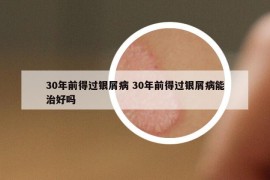 30年前得過銀屑病 30年前得過銀屑病能治好嗎