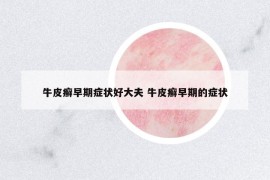牛皮癬早期癥狀好大夫 牛皮癬早期的癥狀