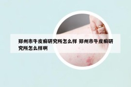 鄭州市牛皮癬研究所怎么樣 鄭州市牛皮癬研究所怎么樣啊