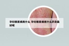 孕婦銀屑病用什么 孕婦銀屑病用什么藥膏最好呢