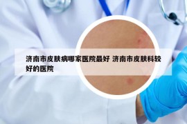 濟南市皮膚病哪家醫(yī)院最好 濟南市皮膚科較好的醫(yī)院