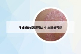 牛皮癬的早期預防 牛皮膚癬預防