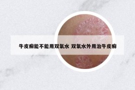 牛皮癬能不能用雙氧水 雙氧水外用治牛皮癬