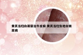 黃芪當(dāng)歸白蒺藜治牛皮癬 黃芪當(dāng)歸生地白銀屑病