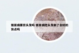銀屑病要剪頭發(fā)嗎 銀屑病把頭發(fā)剃了會好的快點嗎