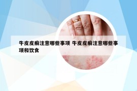 牛皮皮癬注意哪些事項(xiàng) 牛皮皮癬注意哪些事項(xiàng)和飲食