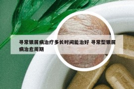 尋常銀屑病治療多長(zhǎng)時(shí)間能治好 尋常型銀屑病治愈周期