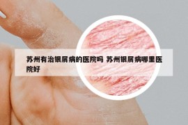 蘇州有治銀屑病的醫(yī)院?jiǎn)?蘇州銀屑病哪里醫(yī)院好