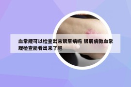 血常規(guī)可以檢查出來銀屑病嗎 銀屑病做血常規(guī)檢查能看出來了吧
