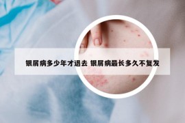 銀屑病多少年才退去 銀屑病最長多久不復(fù)發(fā)