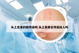 頭上出來的癬傳染嗎 頭上有癬會(huì)傳染給人嗎