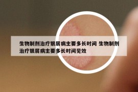 生物制劑治療銀屑病主要多長(zhǎng)時(shí)間 生物制劑治療銀屑病主要多長(zhǎng)時(shí)間見(jiàn)效