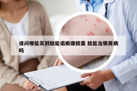 請問哪能買到肽能諾癬康膠囊 肽能治銀屑病嗎