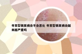 尋常型銀屑病會(huì)不會(huì)惡化 尋常型銀屑病會(huì)越來越嚴(yán)重嗎