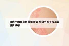 周邊一圈有皮屑是銀屑病 周邊一圈有皮屑是銀屑病嘛
