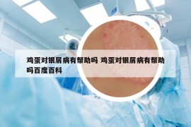 雞蛋對(duì)銀屑病有幫助嗎 雞蛋對(duì)銀屑病有幫助嗎百度百科