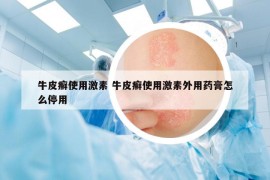 牛皮癬使用激素 牛皮癬使用激素外用藥膏怎么停用