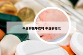 牛皮癬像牛皮嗎 牛皮癬相似